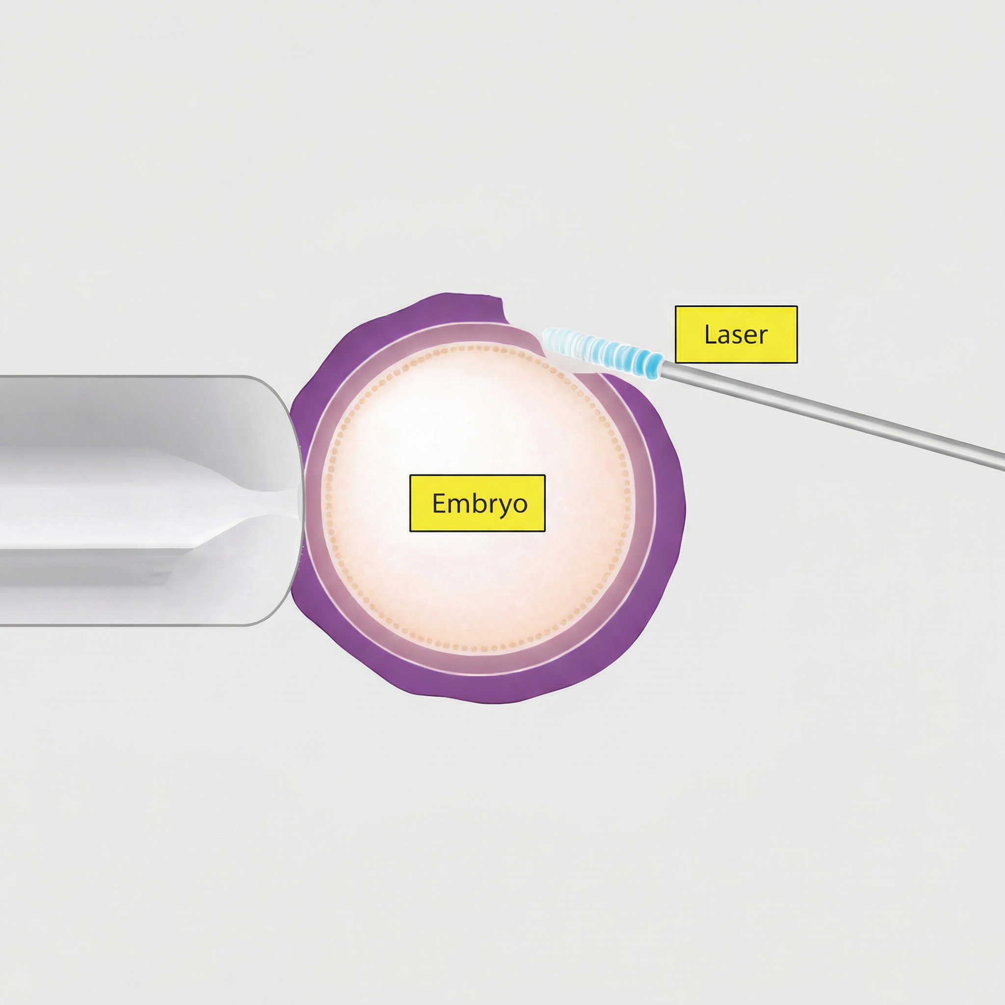 Laser Assisted Embryo Hatching