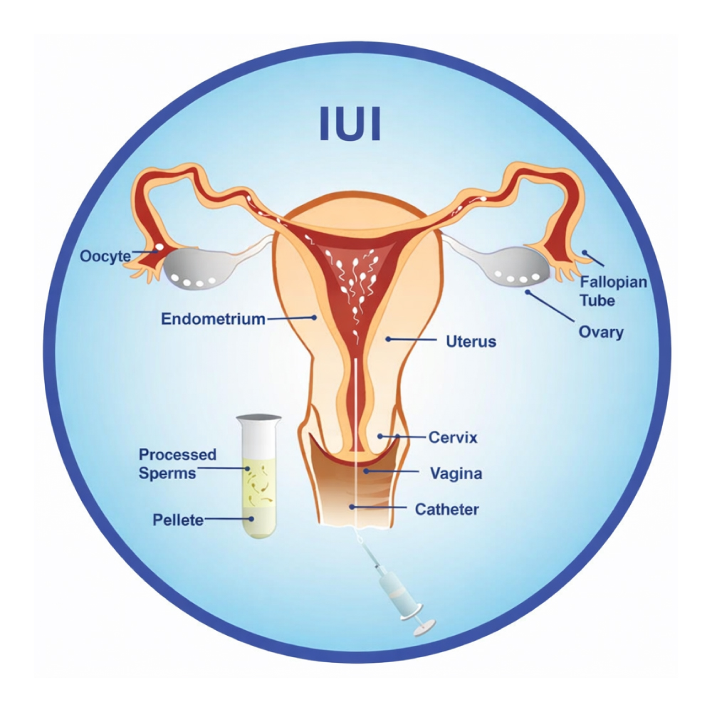 IUI